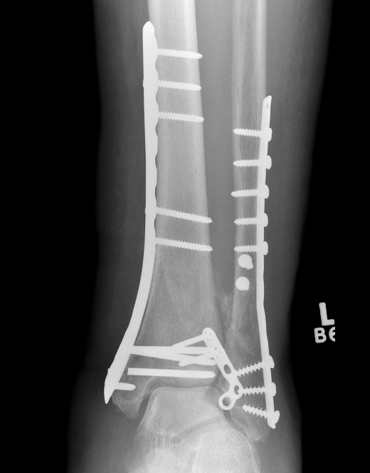 Tibial plafond medial plate 3